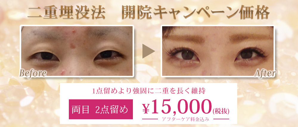 開院キャンペーン!二重術埋没法を両目2点留め15,000円(税抜)