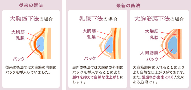 人工乳腺バッグ