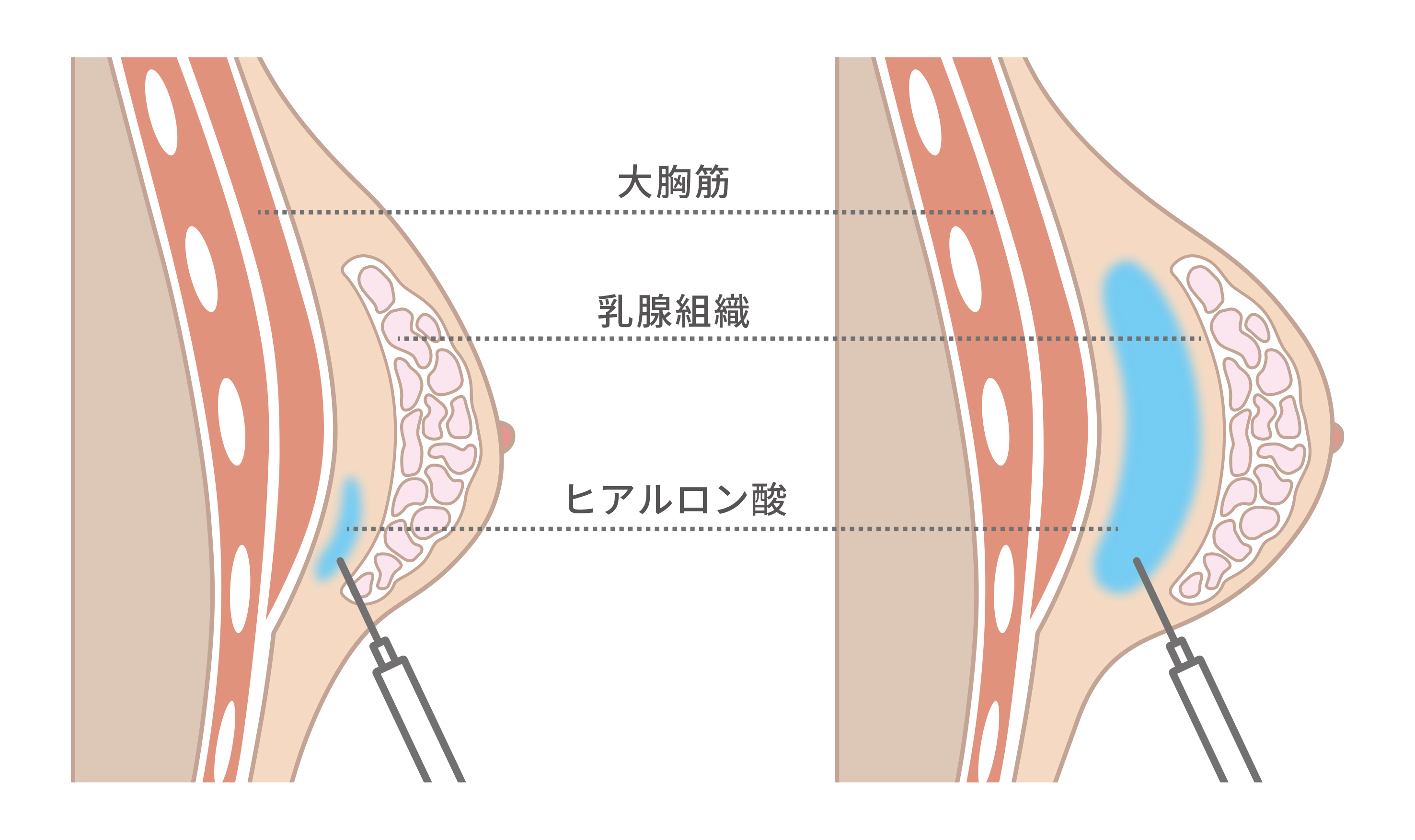ヒアルロン酸注入豊胸で使用する「ヒアルロン酸」の効果とは