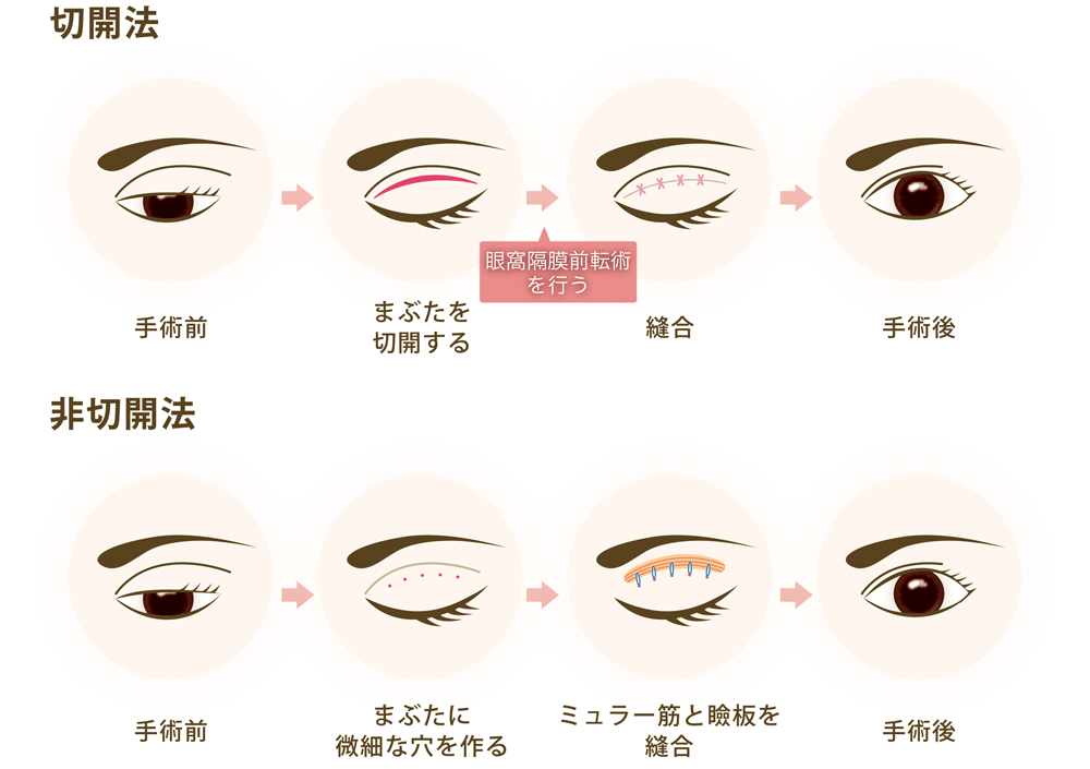 眼瞼下垂の「切開法」と「非切開法」の違い