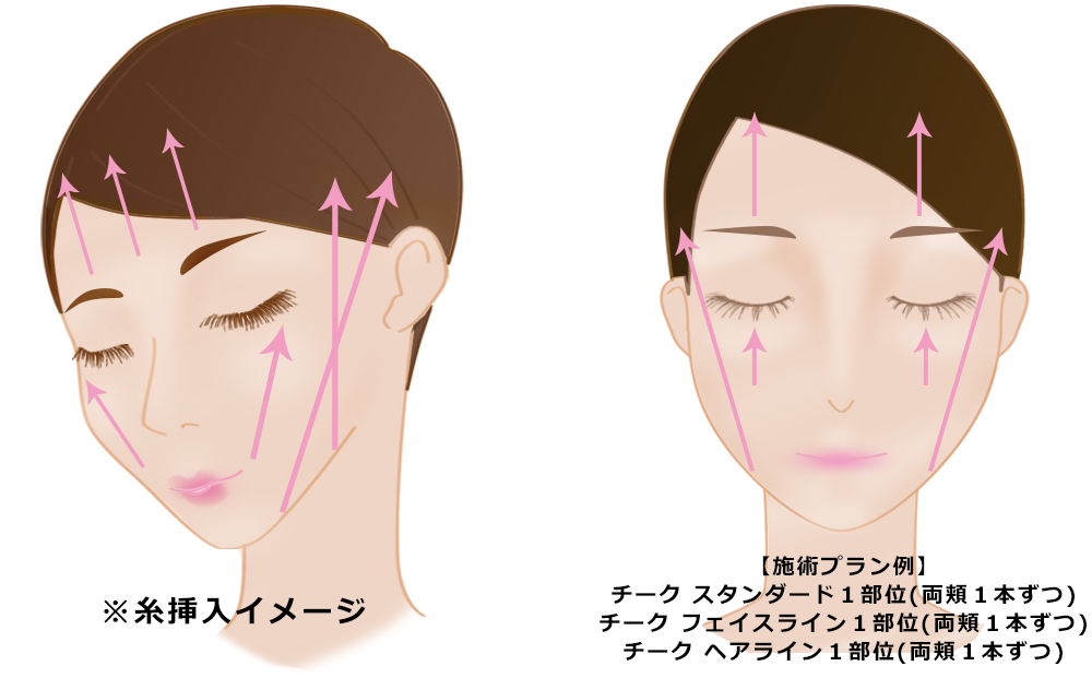 糸の挿入イメージ